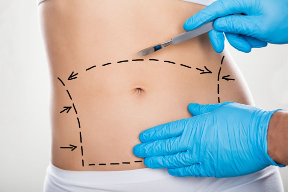 Abdominoplastik Halle Saale